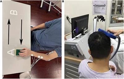 Upper Limbs Muscle Co-contraction Changes Correlated With the Impairment of the Corticospinal Tract in Stroke Survivors: Preliminary Evidence From Electromyography and Motor-Evoked Potential